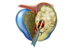 проявление острой формы простатита